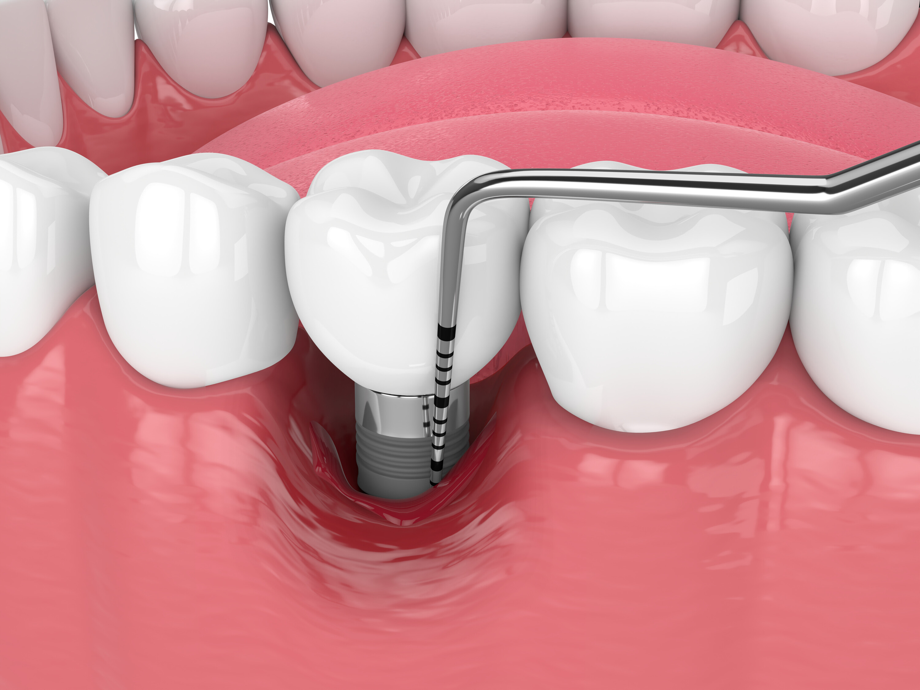 Périimplantite